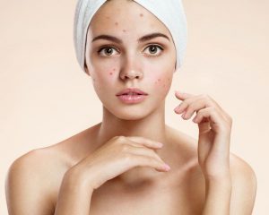 Vad ska man använda och hur man tar hand om huden som påverkas av akne?